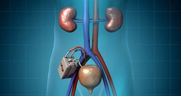 bionic kidney