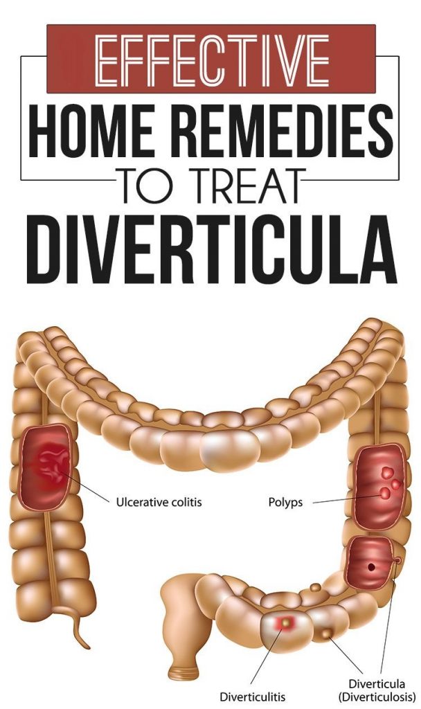 Natural Remedies For Diverticulosis